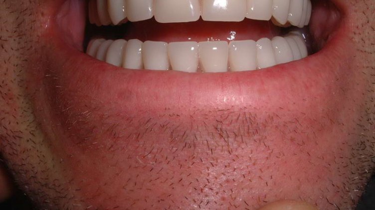 Здравната каса поема част от разходите за зъбни протези