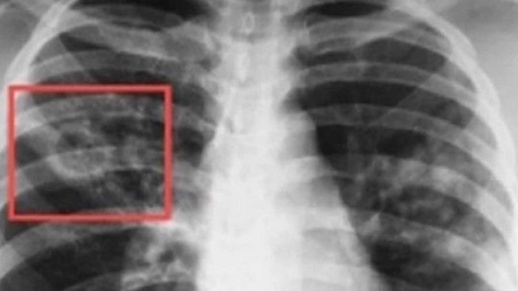 От утре започват безплатни прегледи за туберкулоза