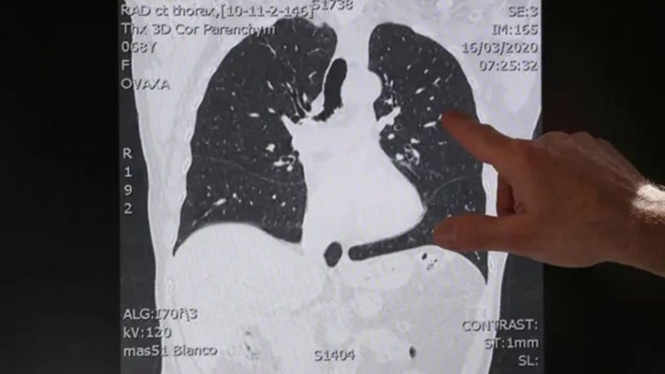 Рентгенолог разкри нанася ли COVID-19 трайни увреждания
