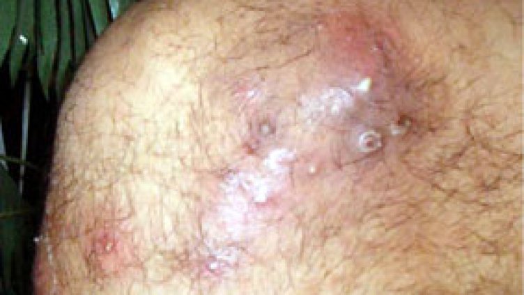 Чумата отново може да се завърне в Европа