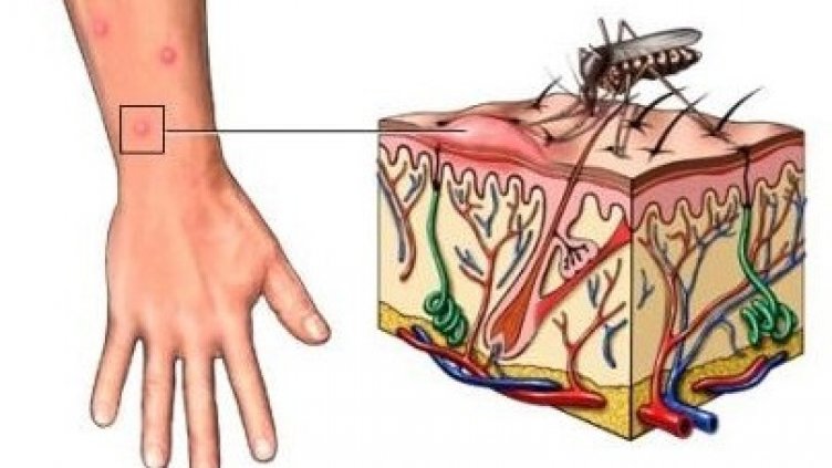 РЗИ-Варна регистрира заболял от Западнонилска треска 