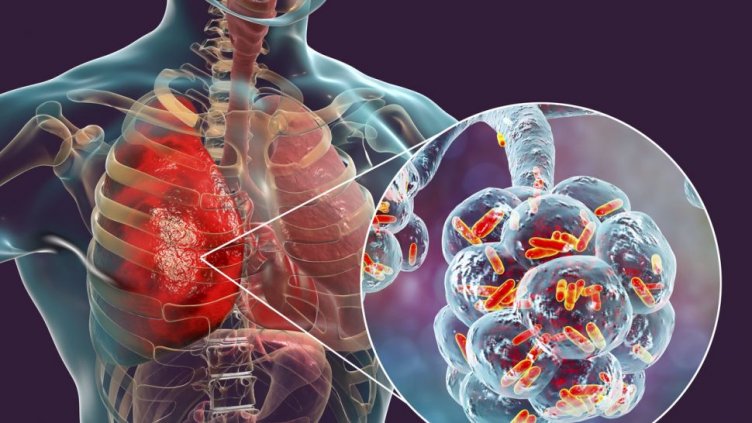 Отбелязваме международния ден за борба с пневмонията
