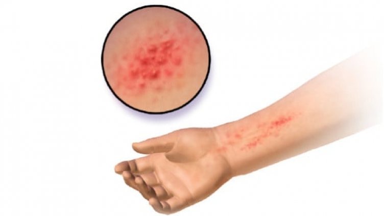 Тестват безплатно за контактен дерматит във Варна