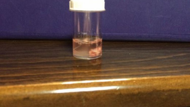 Извадиха 12-сантиметрова гад от окото на момиче