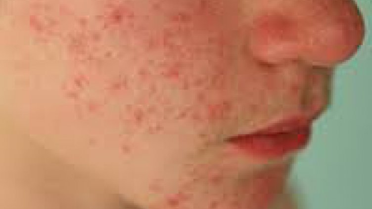 Всяко второ дете с дерматит през 2050 г.