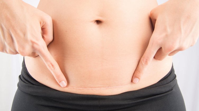 Цезаровото сечение повишава риска от алергии при децата