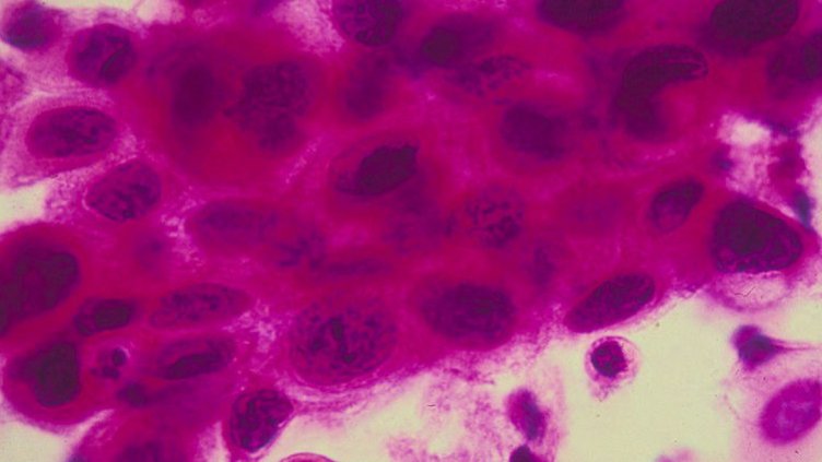 Задава ли се лекарство срещу всички видове рак?