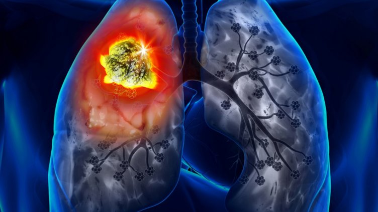 Трайно намаляват болните от туберкулоза 