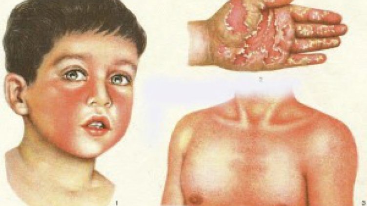 Малиновият език издава скарлатината