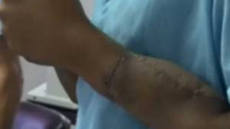 Присадиха нови ръце на индиец