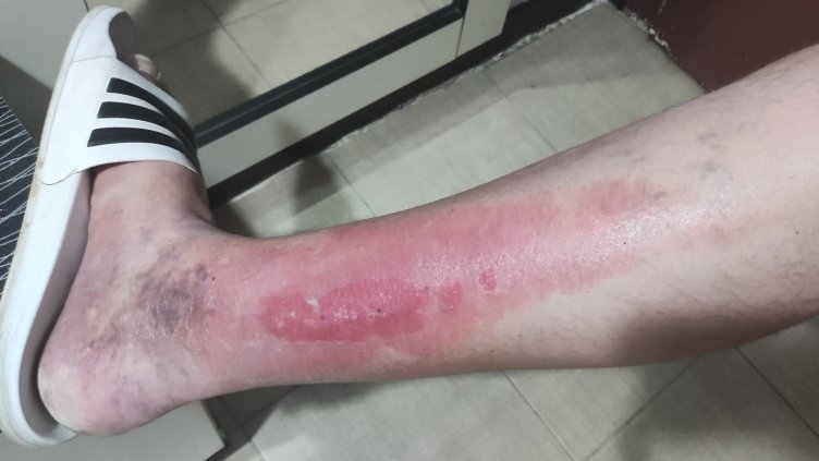 Детски балон гръмна и изгори жестоко баща