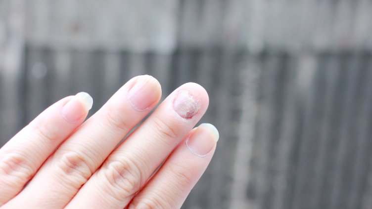 Подготвят кампания, свързана със световния ден на псориазиса