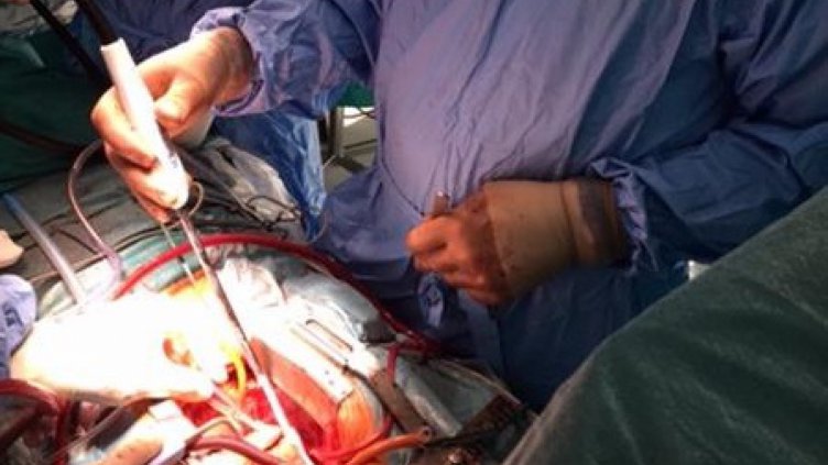 В кардиохирургията във Варна въведоха авангарден метод срещу сърдечни аритмии