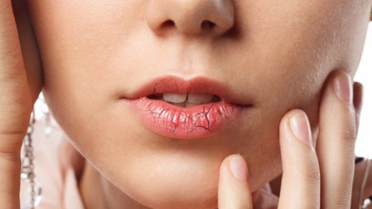 Как да се справите с напуканите устни