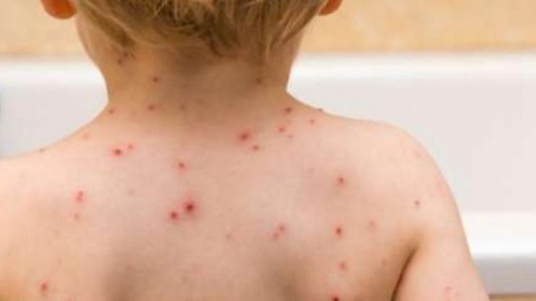 За 86 случая на морбили е съобщено в здравното министерство