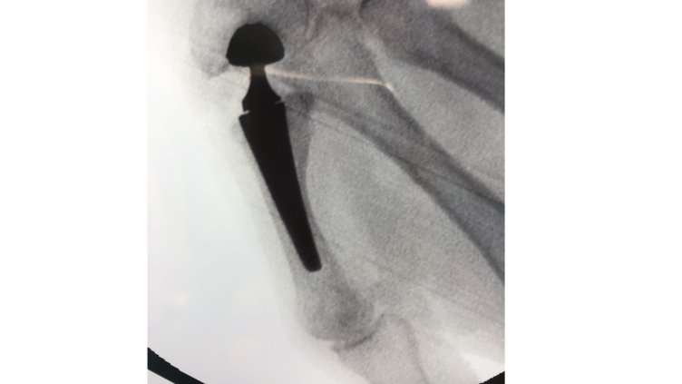 За първи път в България наш топортопед имплантира иновативна и за ЕС протеза на палеца