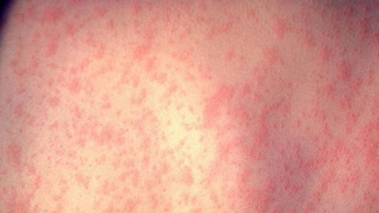 Първият случай на морбили за годината  в България е засечен във Варна