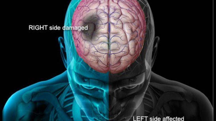 Започва изграждане на мрежа от центрове за лечение на инсулти в България