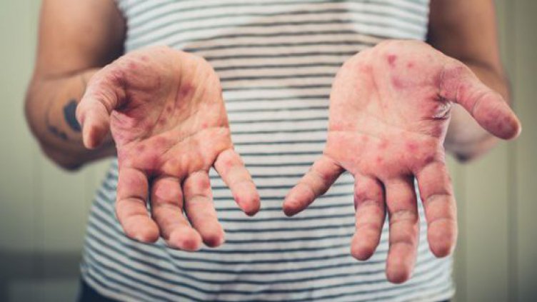 21 души са с потвърдена диагноза морбили у нас!