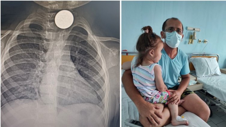 Извадиха монета от хранопровода на дете, глътнало я преди месец и половина (СНИМКИ)