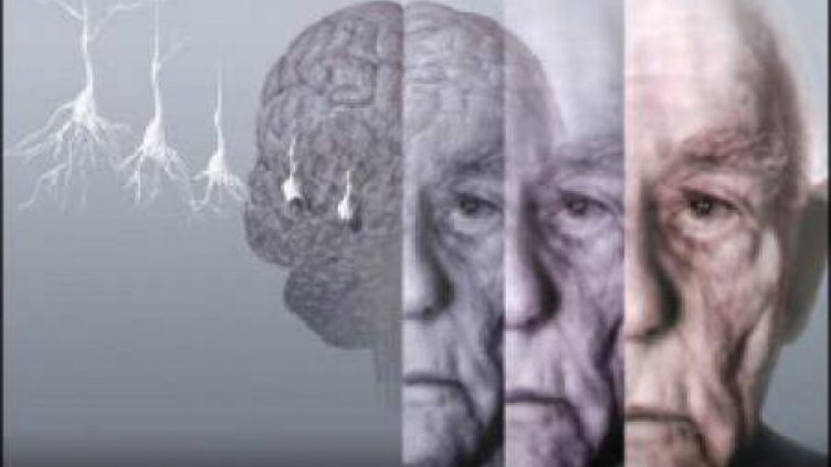 Спрей с инсулин действа срещу алцхаймер