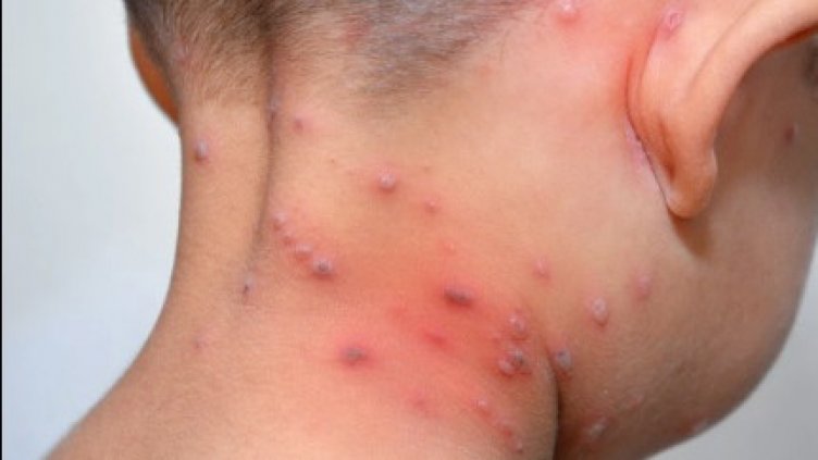 Огромен ръст на болните от шарки във Варна