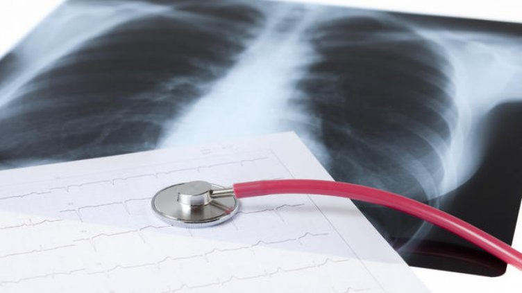 Отбелязваме Световния ден за борба с туберкулозата