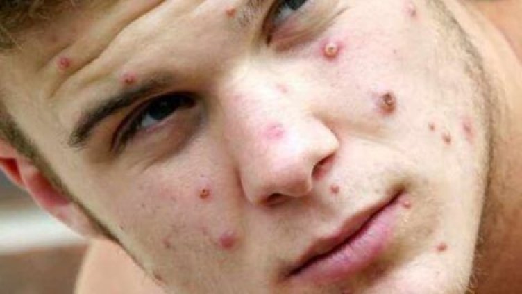 Маймунската шарка вече шари в 29 страни. Най-много има във Великобритания