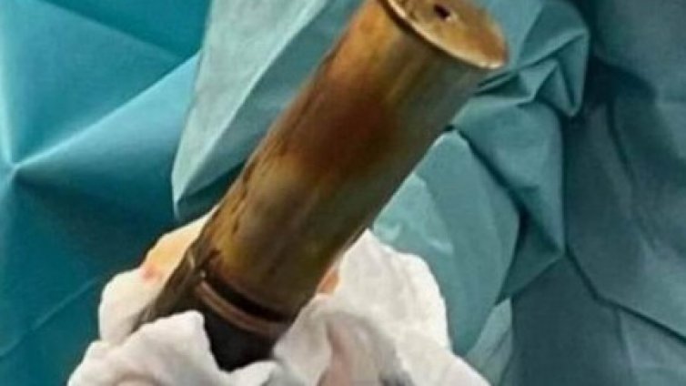 Находка: Извадиха снаряд от Първата световна война от ануса на мъж