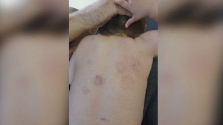 Отстраниха директорката и две медицински сестри от градината, където нахапаха дете